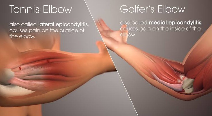whats the difference between tennis elbow and golf elbow